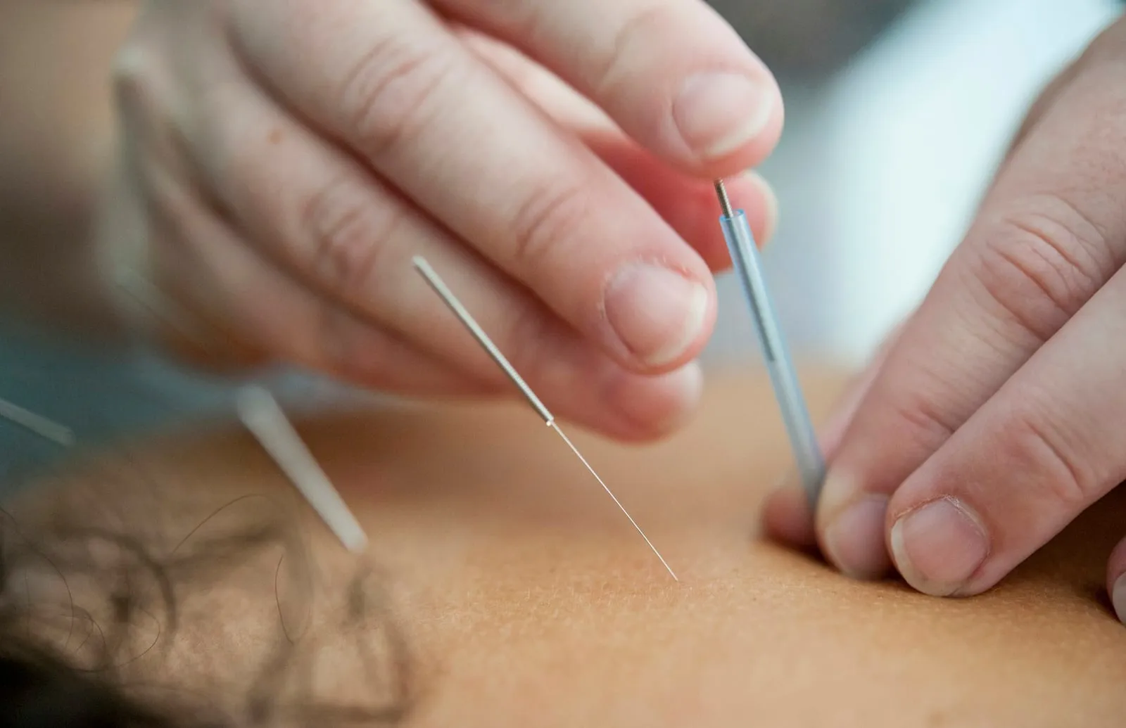 Acupuncture needles inserted into the skin