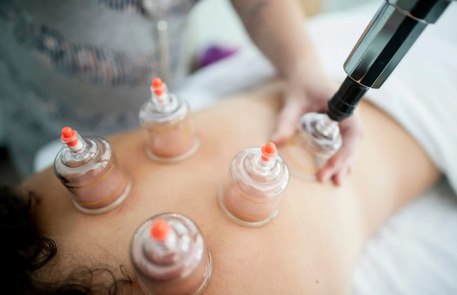 Glass cups placed on a person’s back